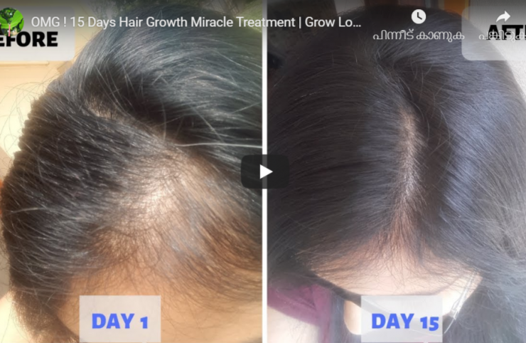15 Days Hair Growth Miracle Treatment