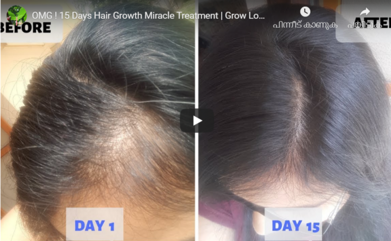 15 Days Hair Growth Miracle Treatment